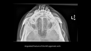 Angulated fracture of the left zygomatic arch.
 