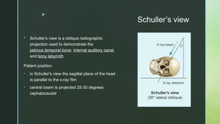 z
Schuller’s view
 Schuller's view is a oblique radiographic
projection used to demonstrate the
petrous temporal bone, internal auditory canal
and bony labyrinth
Patient position
• in Schuller's view the sagittal plane of the head
is parallel to the x-ray film
• central beam is projected 25-30 degrees
cephalocaudal
 