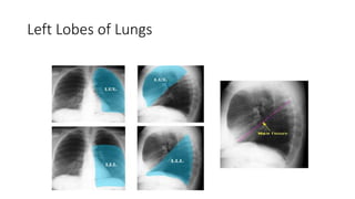 Left Lobes of Lungs
 