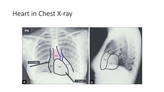 Heart in Chest X-ray
 