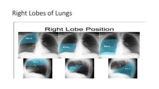 Right Lobes of Lungs
 