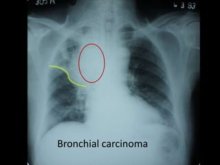 Bronchial carcinoma
 