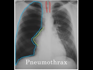 Pneumothrax
 
