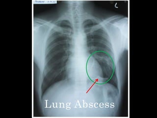 Lung Abscess
 