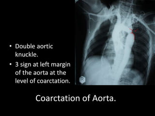 • Double aortic
  knuckle.
• 3 sign at left margin
  of the aorta at the
  level of coarctation.

         Coarctation of Aorta.
 