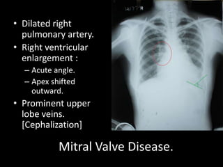 • Dilated right
  pulmonary artery.
• Right ventricular
  enlargement :
  – Acute angle.
  – Apex shifted
    outward.
• Prominent upper
  lobe veins.
  [Cephalization]

           Mitral Valve Disease.
 