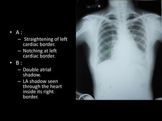 • A:
  – Straightening of left
    cardiac border.
  – Notching at left
    cardiac border.
• B:
  – Double atrial
    shadow.
  – LA shadow seen
    through the heart
    inside its right
    border.
 