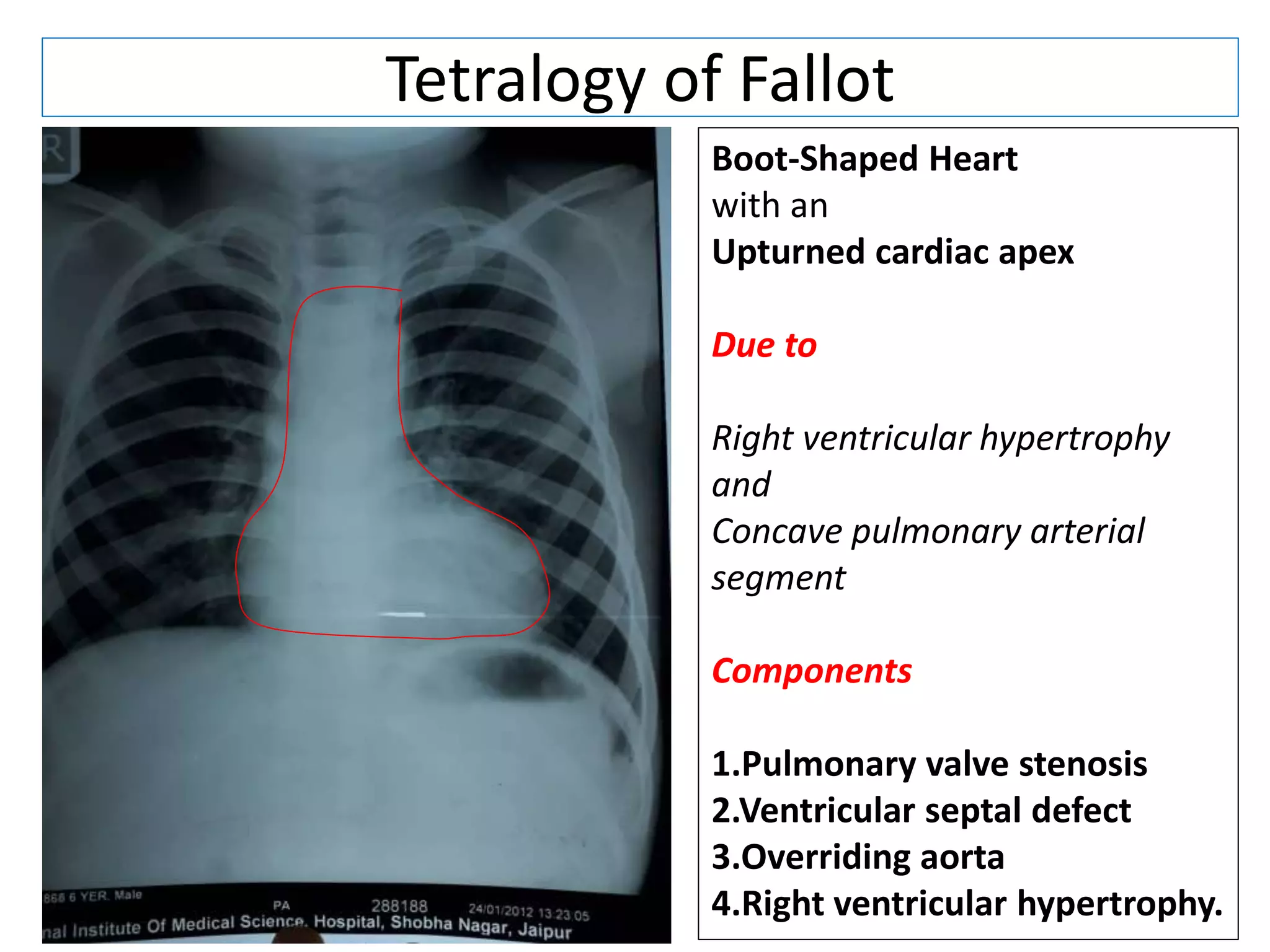 Tetralogy of Fallot
Boot-Shaped Heart
with an
Upturned cardiac apex
Due to
Right ventricular hypertrophy
and
Concave pulmonary arterial
segment
Components
1.Pulmonary valve stenosis
2.Ventricular septal defect
3.Overriding aorta
4.Right ventricular hypertrophy.
 