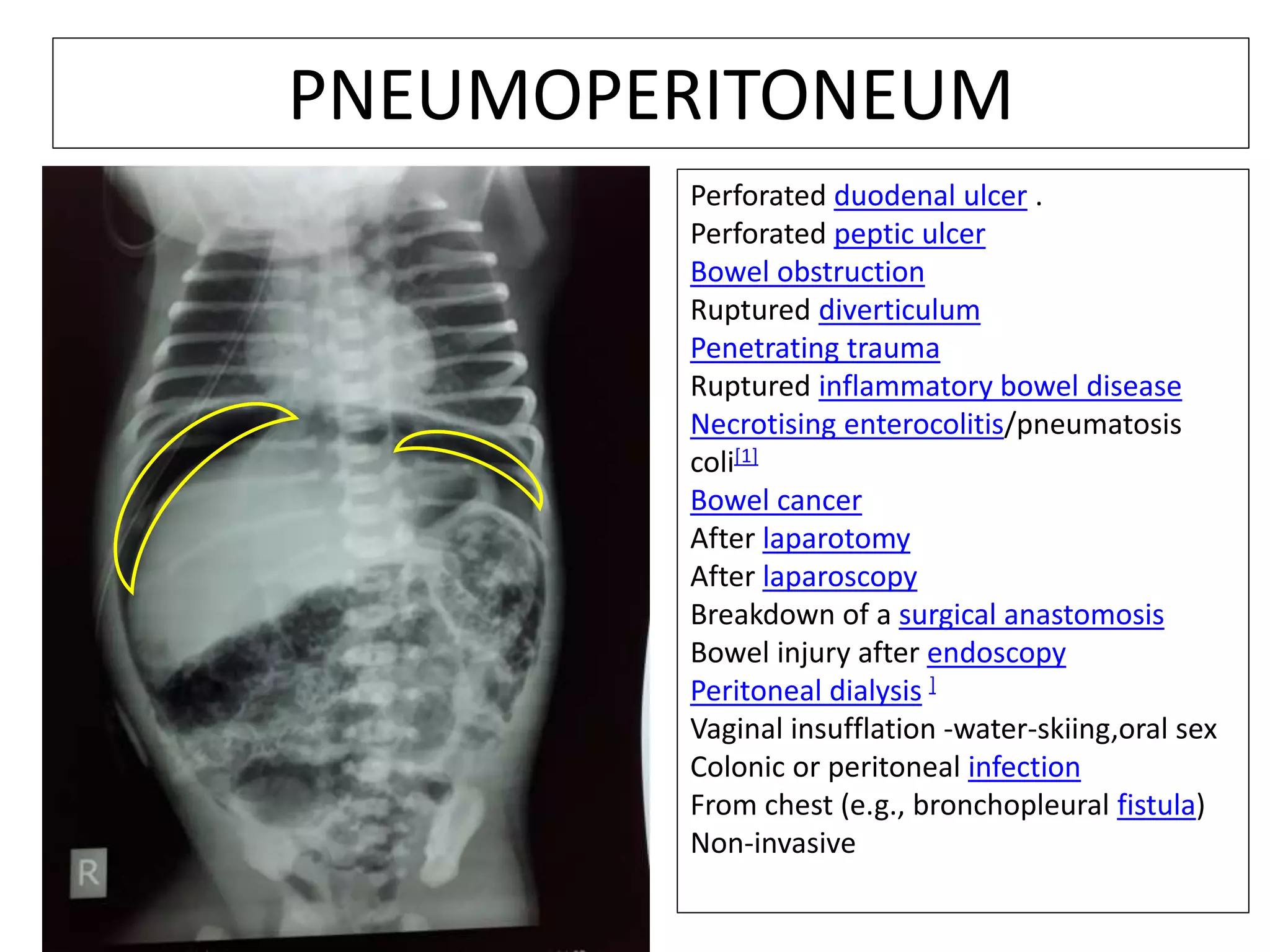 PNEUMOPERITONEUM
Perforated duodenal ulcer .
Perforated peptic ulcer
Bowel obstruction
Ruptured diverticulum
Penetrating trauma
Ruptured inflammatory bowel disease
Necrotising enterocolitis/pneumatosis
coli[1]
Bowel cancer
After laparotomy
After laparoscopy
Breakdown of a surgical anastomosis
Bowel injury after endoscopy
Peritoneal dialysis ]
Vaginal insufflation -water-skiing,oral sex
Colonic or peritoneal infection
From chest (e.g., bronchopleural fistula)
Non-invasive
 
