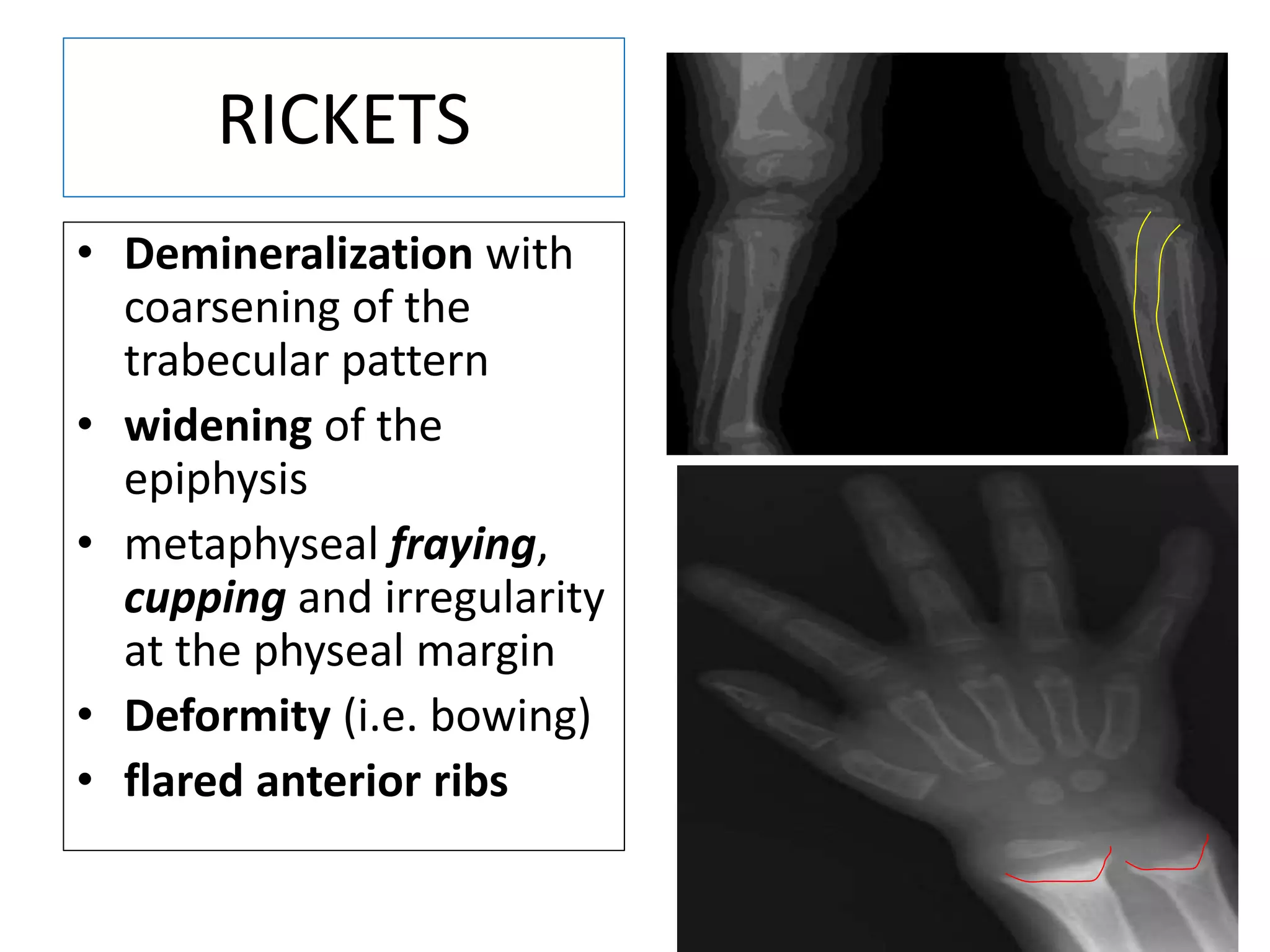 RICKETS
• Demineralization with
coarsening of the
trabecular pattern
• widening of the
epiphysis
• metaphyseal fraying,
cupping and irregularity
at the physeal margin
• Deformity (i.e. bowing)
• flared anterior ribs
 