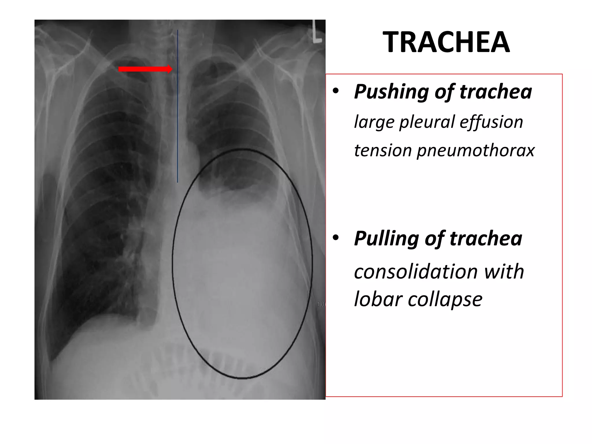 TRACHEA
• Pushing of trachea
large pleural effusion
tension pneumothorax
• Pulling of trachea
consolidation with
lobar collapse
 