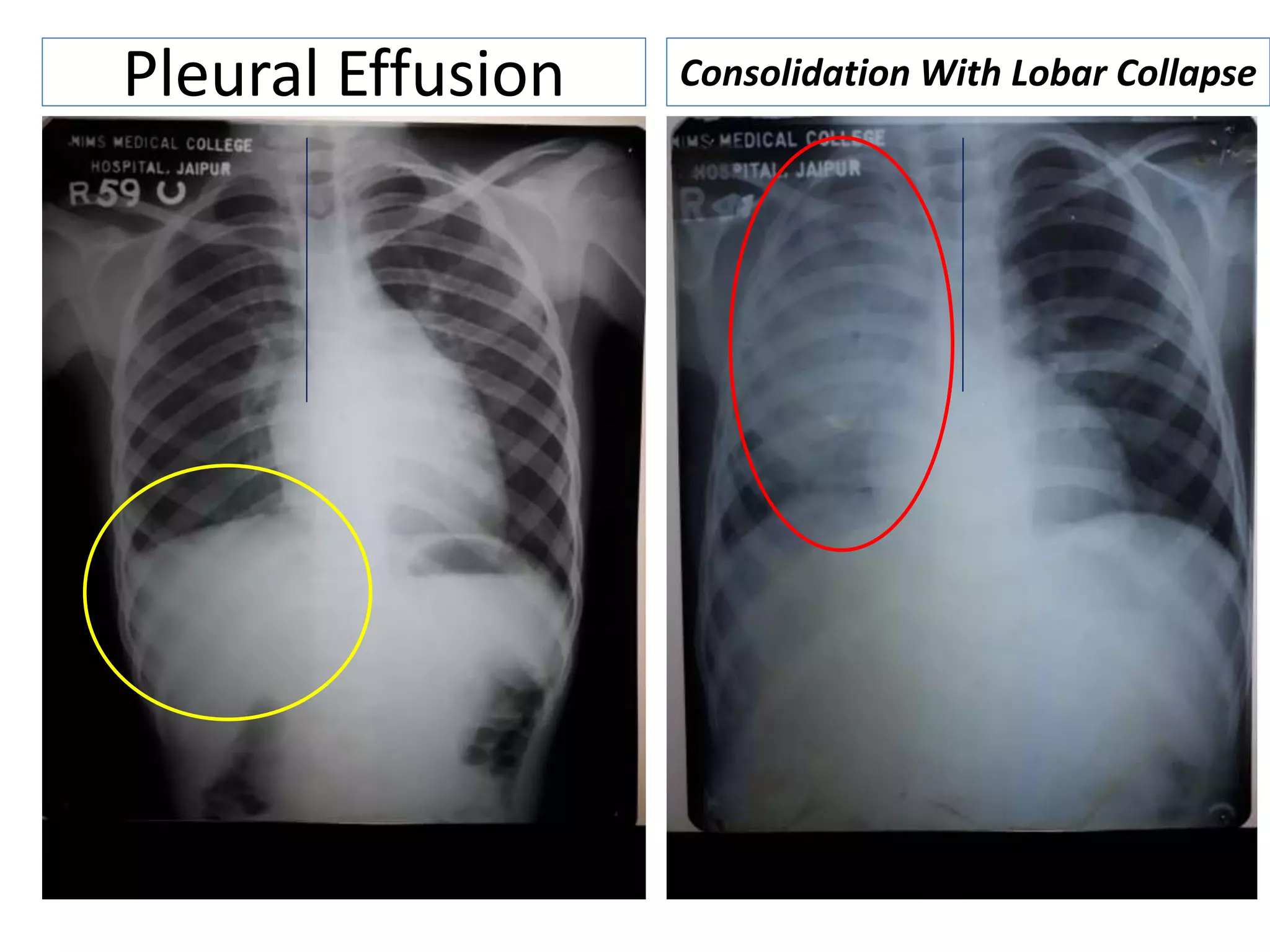 Pleural Effusion Consolidation With Lobar Collapse
 