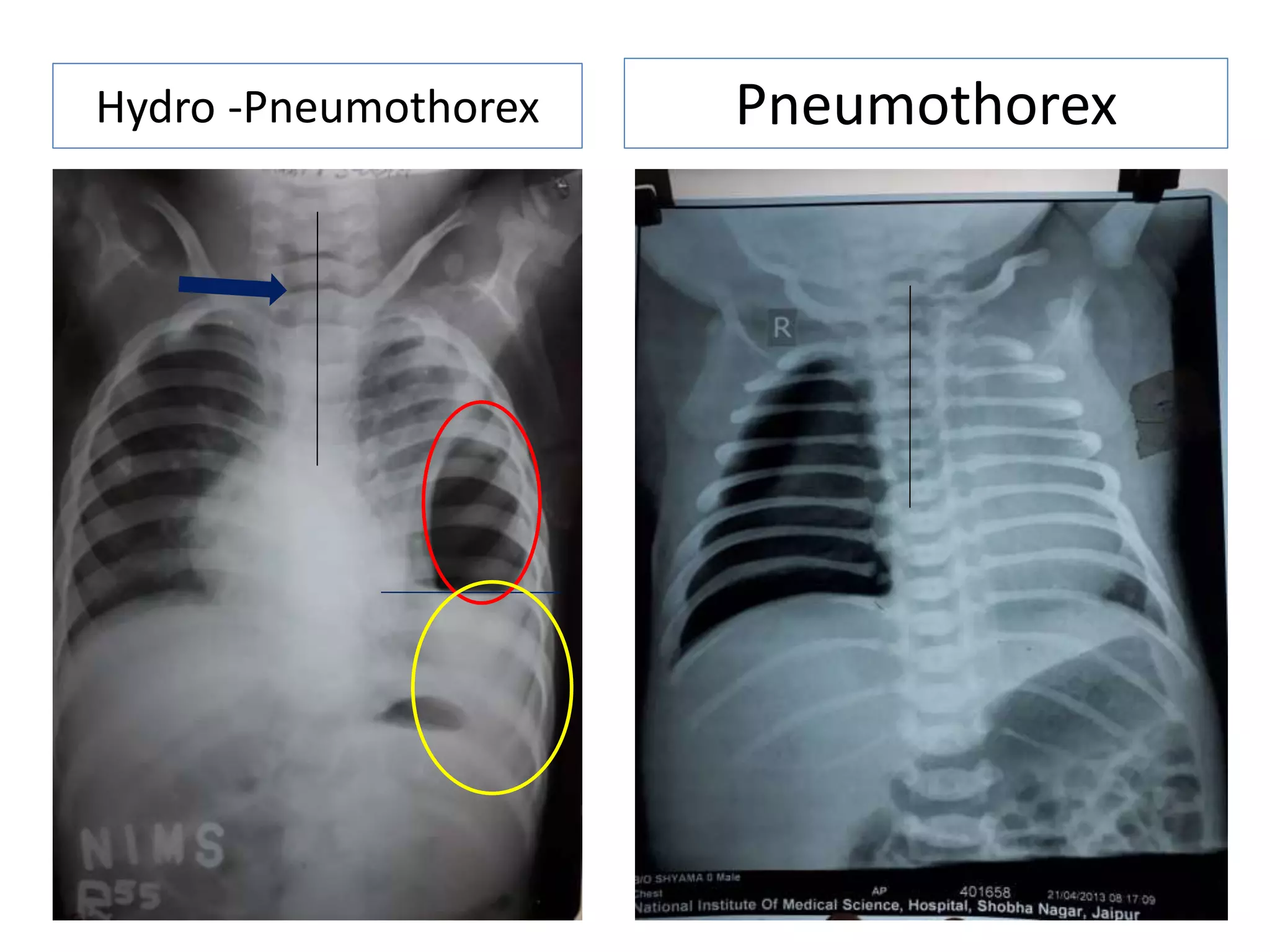 Hydro -Pneumothorex Pneumothorex
 