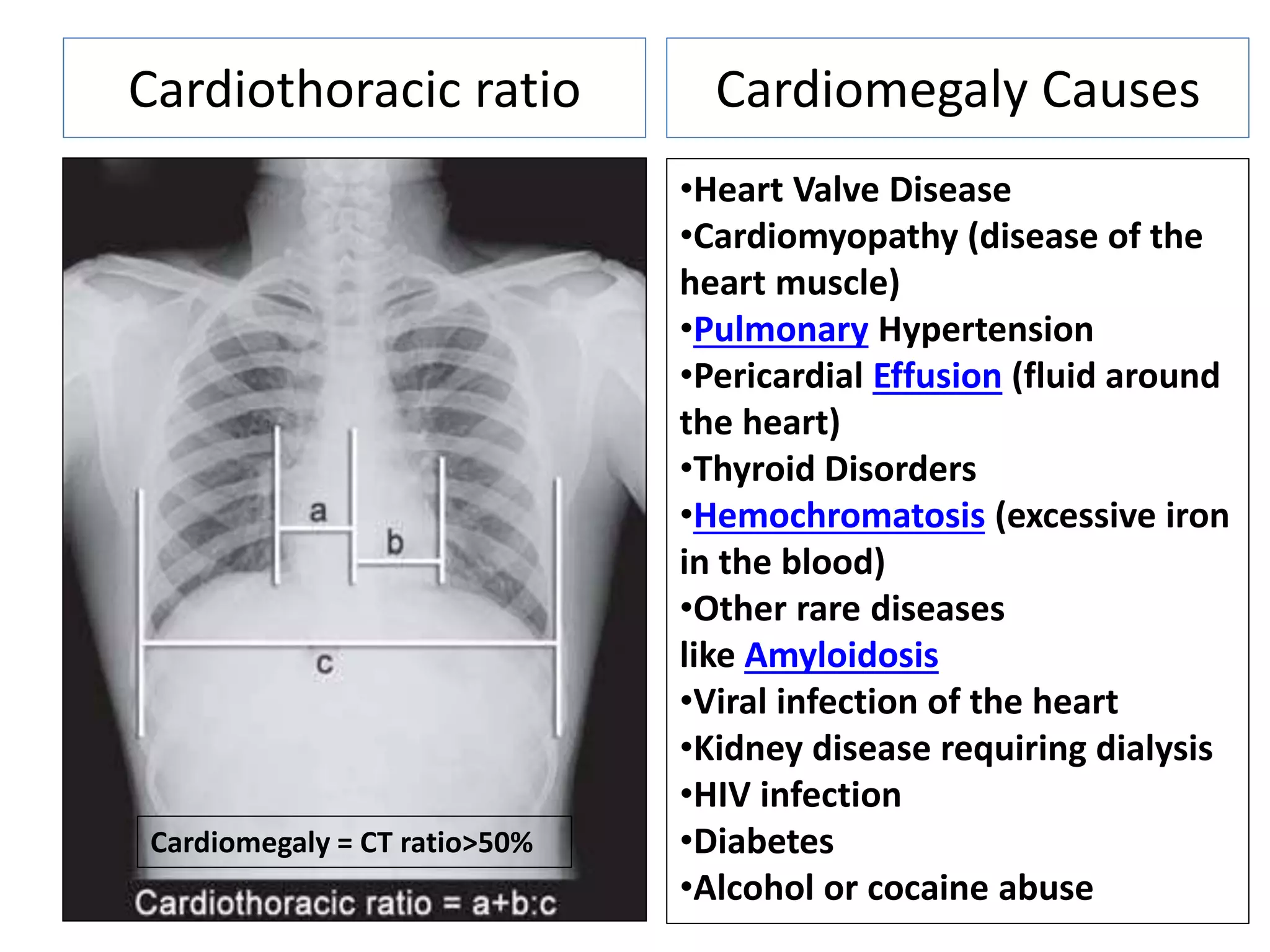 Cardiothoracic ratio Cardiomegaly Causes
•Heart Valve Disease
•Cardiomyopathy (disease of the
heart muscle)
•Pulmonary Hypertension
•Pericardial Effusion (fluid around
the heart)
•Thyroid Disorders
•Hemochromatosis (excessive iron
in the blood)
•Other rare diseases
like Amyloidosis
•Viral infection of the heart
•Kidney disease requiring dialysis
•HIV infection
•Diabetes
•Alcohol or cocaine abuse
Cardiomegaly = CT ratio>50%
 