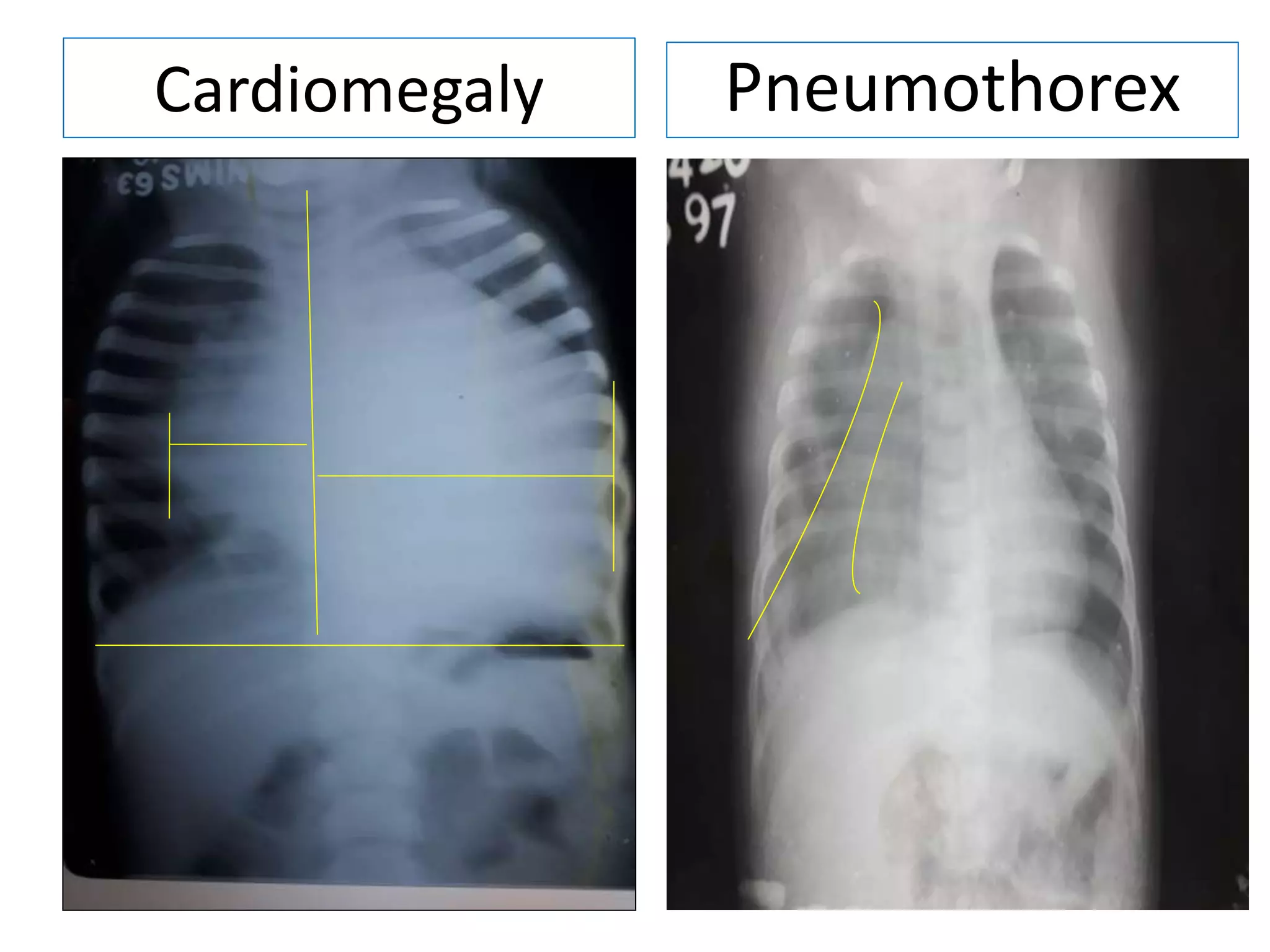 Cardiomegaly Pneumothorex
 