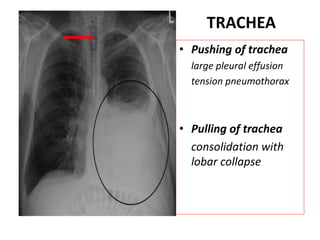 TRACHEA
• Pushing of trachea
large pleural effusion
tension pneumothorax
• Pulling of trachea
consolidation with
lobar collapse
 