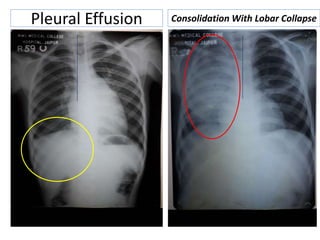 Pleural Effusion Consolidation With Lobar Collapse
 