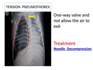 TENSION- PNEUMOTHOREX
One-way valve and
not allow the air to
exit
Treatment
Needle Decompression
 