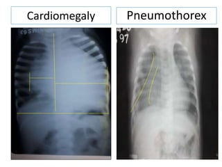 Cardiomegaly Pneumothorex
 