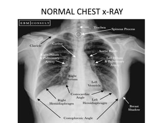 normal chest xray labeled