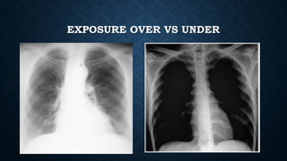 EXPOSURE OVER VS UNDER
 