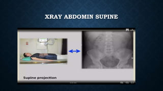 XRAY ABDOMIN SUPINE
 
