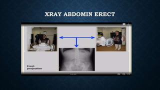 XRAY ABDOMIN ERECT
 