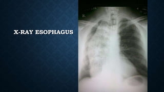 X-RAY ESOPHAGUS
 