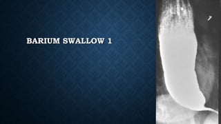 BARIUM SWALLOW 1
 