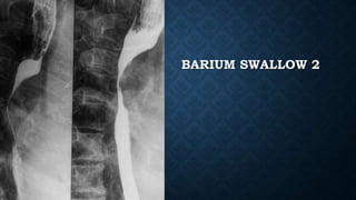 BARIUM SWALLOW 2
 