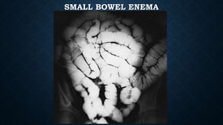 SMALL BOWEL ENEMA
 