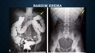BARIUM ENEMA
 
