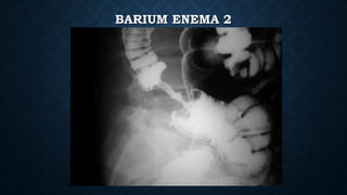 BARIUM ENEMA 2
 
