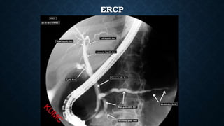 ERCP