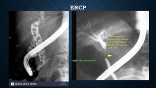ERCP
 