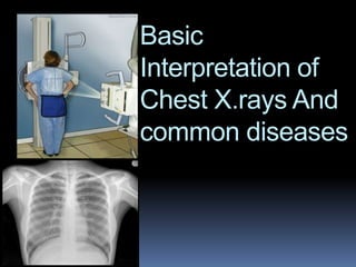 Basic
Interpretation of
Chest X.rays And
common diseases
 