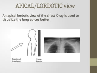 Lordotic View xray seminar of radiology department hims | PPTX