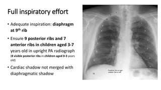 Full inspiratory effort
• Adequate inspiration: diaphragm
at 9th rib
• Ensure 9 posterior ribs and 7
anterior ribs in children aged 3-7
years old in upright PA radiograph
(8 visible posterior ribs in children aged 0-3 years
old)
• Cardiac shadow not merged with
diaphragmatic shadow
 