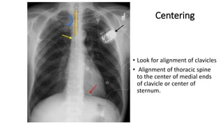 • Look for alignment of clavicles
• Alignment of thoracic spine
to the center of medial ends
of clavicle or center of
sternum.
Centering
 