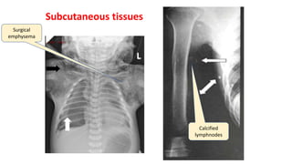 Subcutaneous tissues
Surgical
emphysema
Calcified
lymphnodes
 