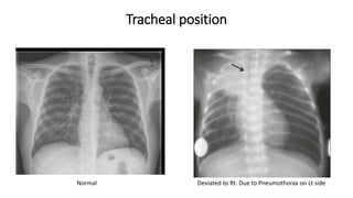 Tracheal position
Normal Deviated to Rt. Due to Pneumothorax on Lt side
 