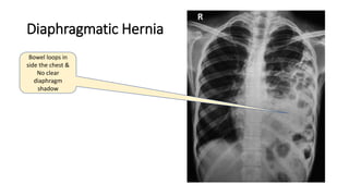 Diaphragmatic Hernia
Bowel loops in
side the chest &
No clear
diaphragm
shadow
 