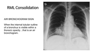 RML Consolidation
AIR BRONCHOGRAM SIGN
When the internal tubular outline
of a bronchus is visible within a
thoracic opacity…that is an air
bronchogram.
 