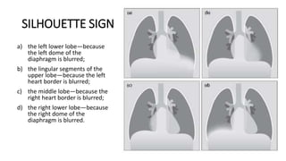 SILHOUETTE SIGN
a) the left lower lobe—because
the left dome of the
diaphragm is blurred;
b) the lingular segments of the
upper lobe—because the left
heart border is blurred;
c) the middle lobe—because the
right heart border is blurred;
d) the right lower lobe—because
the right dome of the
diaphragm is blurred.
 