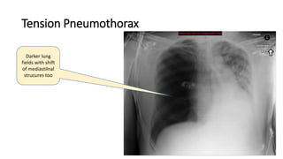 Tension Pneumothorax
Darker lung
fields with shift
of mediastilnal
strucures too
 