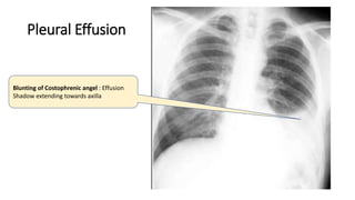 Pleural Effusion
Blunting of Costophrenic angel : Effusion
Shadow extending towards axilla
 