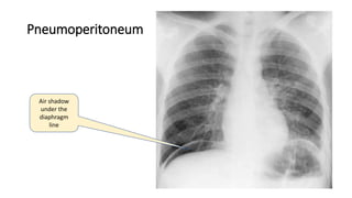 Pneumoperitoneum
Air shadow
under the
diaphragm
line
 
