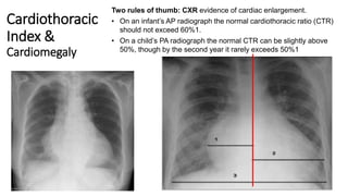 Cardiothoracic
Index &
Cardiomegaly
Two rules of thumb: CXR evidence of cardiac enlargement.
• On an infant’s AP radiograph the normal cardiothoracic ratio (CTR)
should not exceed 60%1.
• On a child’s PA radiograph the normal CTR can be slightly above
50%, though by the second year it rarely exceeds 50%1
 