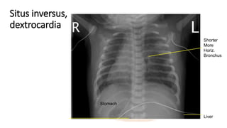 Situs inversus,
dextrocardia
Shorter
More
Horiz.
Bronchus
Liver
Stomach
 