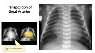 Transposition of
Great Arteries
Egg on end appearance
 